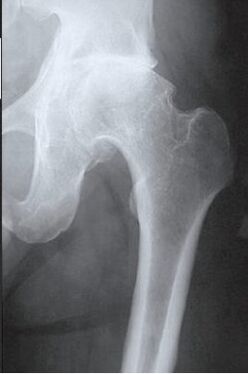 MRI of the affected hip joint