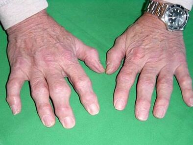 osteoarthritis of the fingers