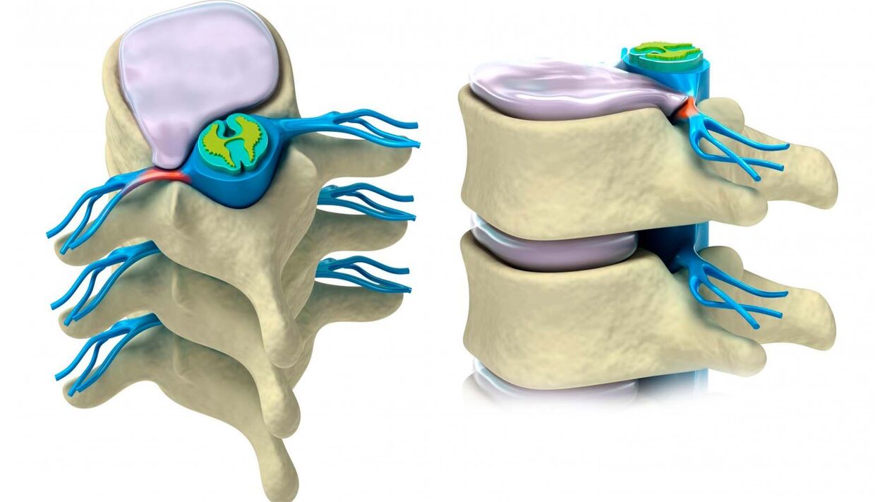 damaged spinal disc