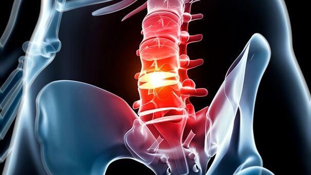 osteochondrosis of the lumbar column