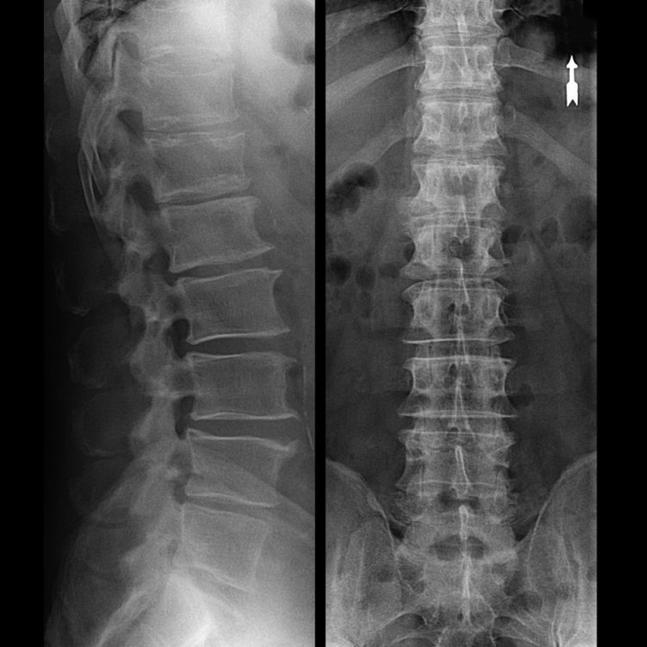 osteochondrosis of the spinal region on x-ray