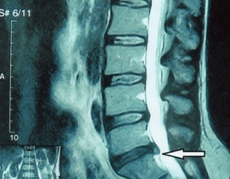 protrusion of a vertebral disc on an MRI