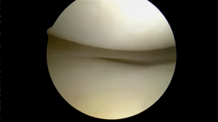 astroscope view of completely healthy surfaces
