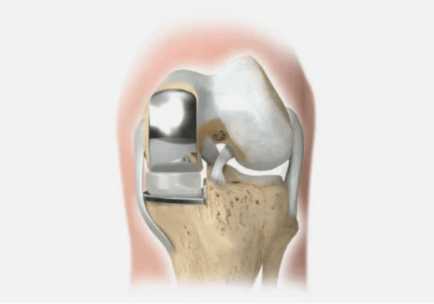 part of the joint is damaged