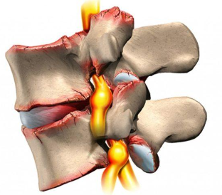 Osteochondrosis of the spine